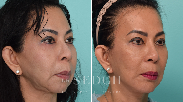 Revision Facelift and Chin Augmentation Before and After | Sedgh