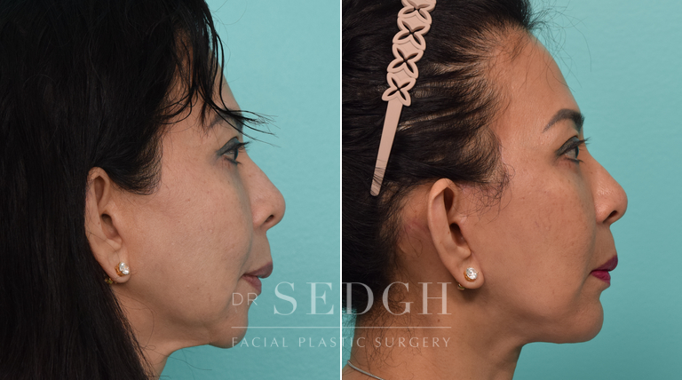 Revision Facelift and Chin Augmentation Before and After | Sedgh