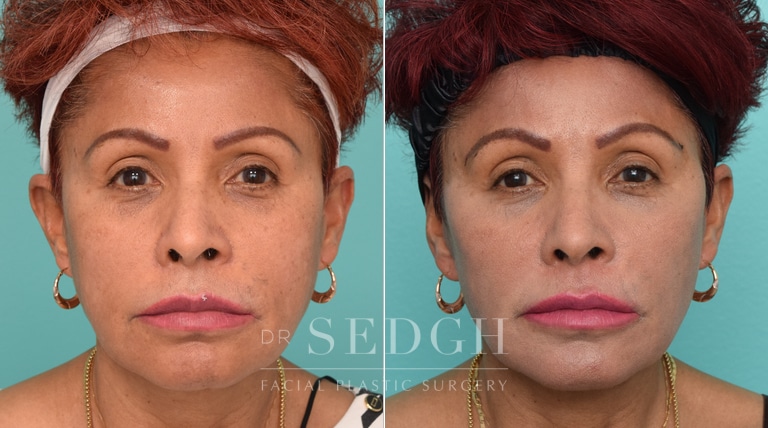 Female Patient Before and After Revision Facelift, Mini Facelift, Fat Grafting | Sedgh