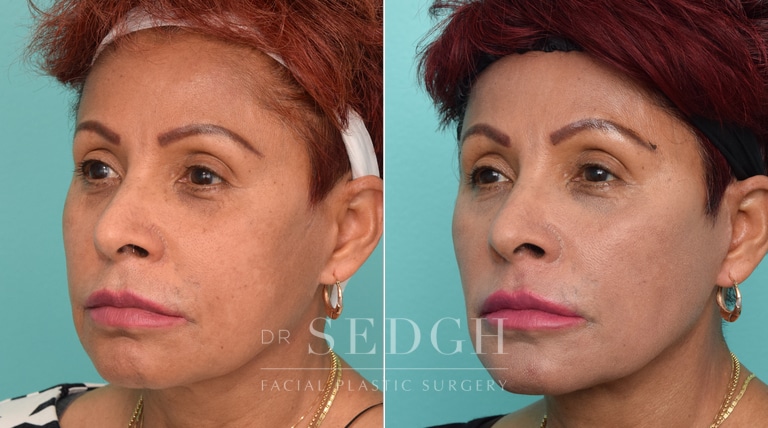 Female Patient Before and After Revision Facelift, Mini Facelift, Fat Grafting | Sedgh