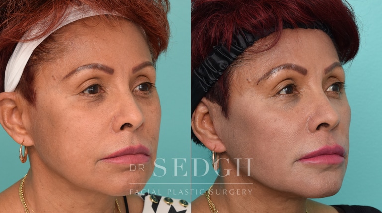 Female Patient Before and After Revision Facelift, Mini Facelift, Fat Grafting | Sedgh