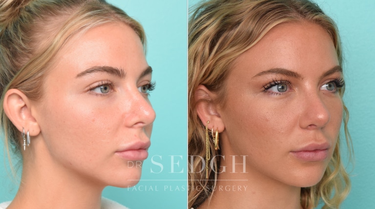 Female Patient Before and After Revision Rhinoplasty | Sedgh