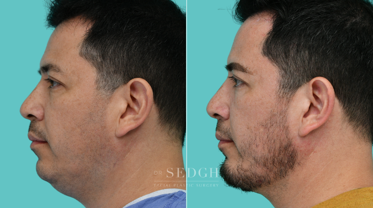 374 Male Face Tite, Neck Liposuction, Chin Augmentation, Lower Bleph, Eyebrow Lift, Micro RF