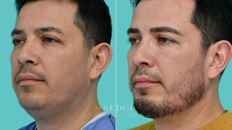 374 Male Face Tite, Neck Liposuction, Chin Augmentation, Lower Bleph, Eyebrow Lift, Micro RF