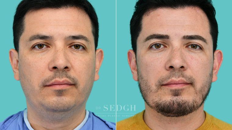 374 Male Face Tite, Neck Liposuction, Chin Augmentation, Lower Bleph, Eyebrow Lift, Micro RF
