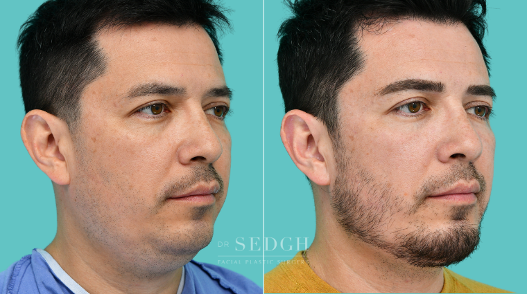 374 Male Face Tite, Neck Liposuction, Chin Augmentation, Lower Bleph, Eyebrow Lift, Micro RF
