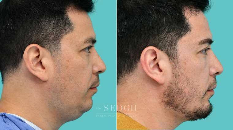 374 Male Face Tite, Neck Liposuction, Chin Augmentation, Lower Bleph, Eyebrow Lift, Micro RF
