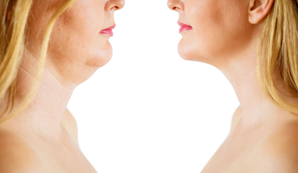 Example of Before And After Cosmetic Surgery - Face and Neck Lift