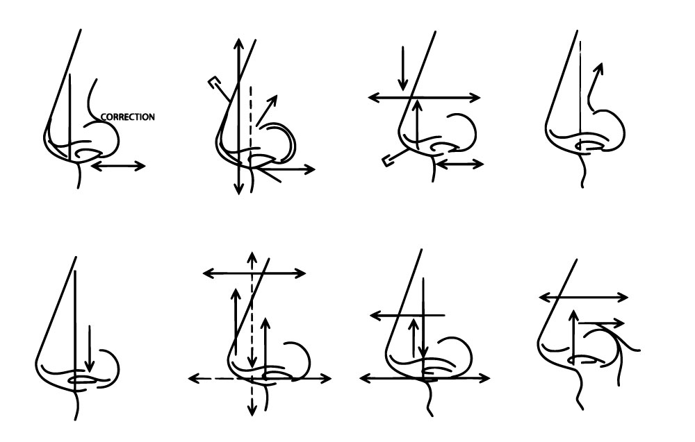 Different Type Of Rhinoplasty Explained