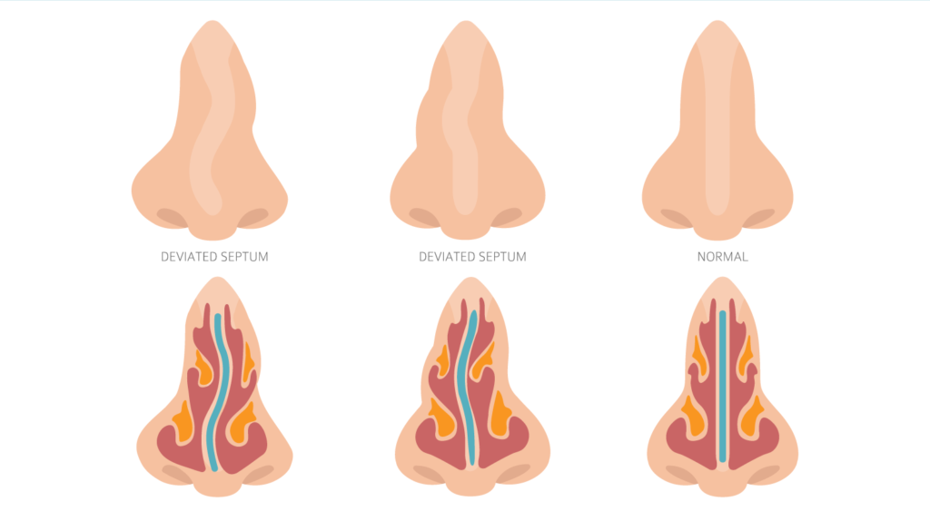 Deviated Septum Diagram - Internal & External