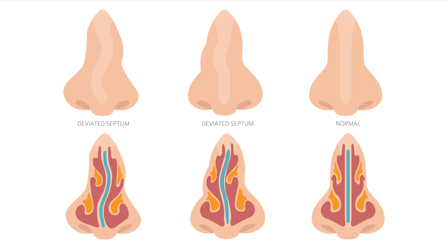 Deviated Septum Diagram - Internal & External
