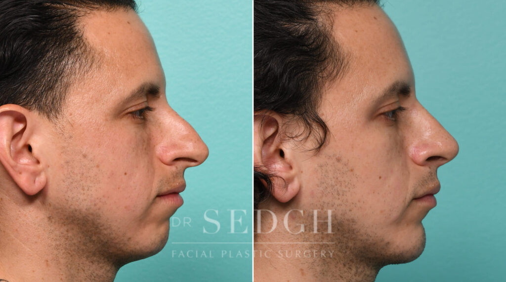 Before & After Phone Of Male Chin Implant Surgery