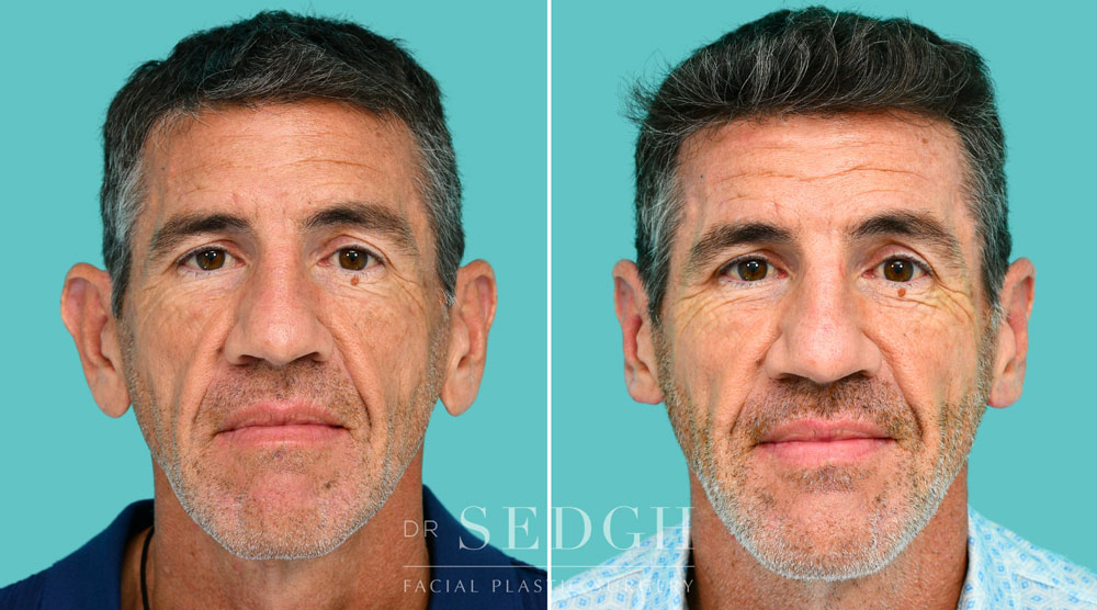Before and After Photo of Male Otoplasty Surgery